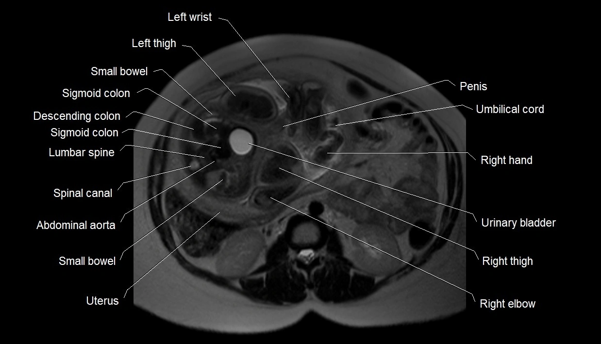 MRI fetal anatomy axial image 7.webp